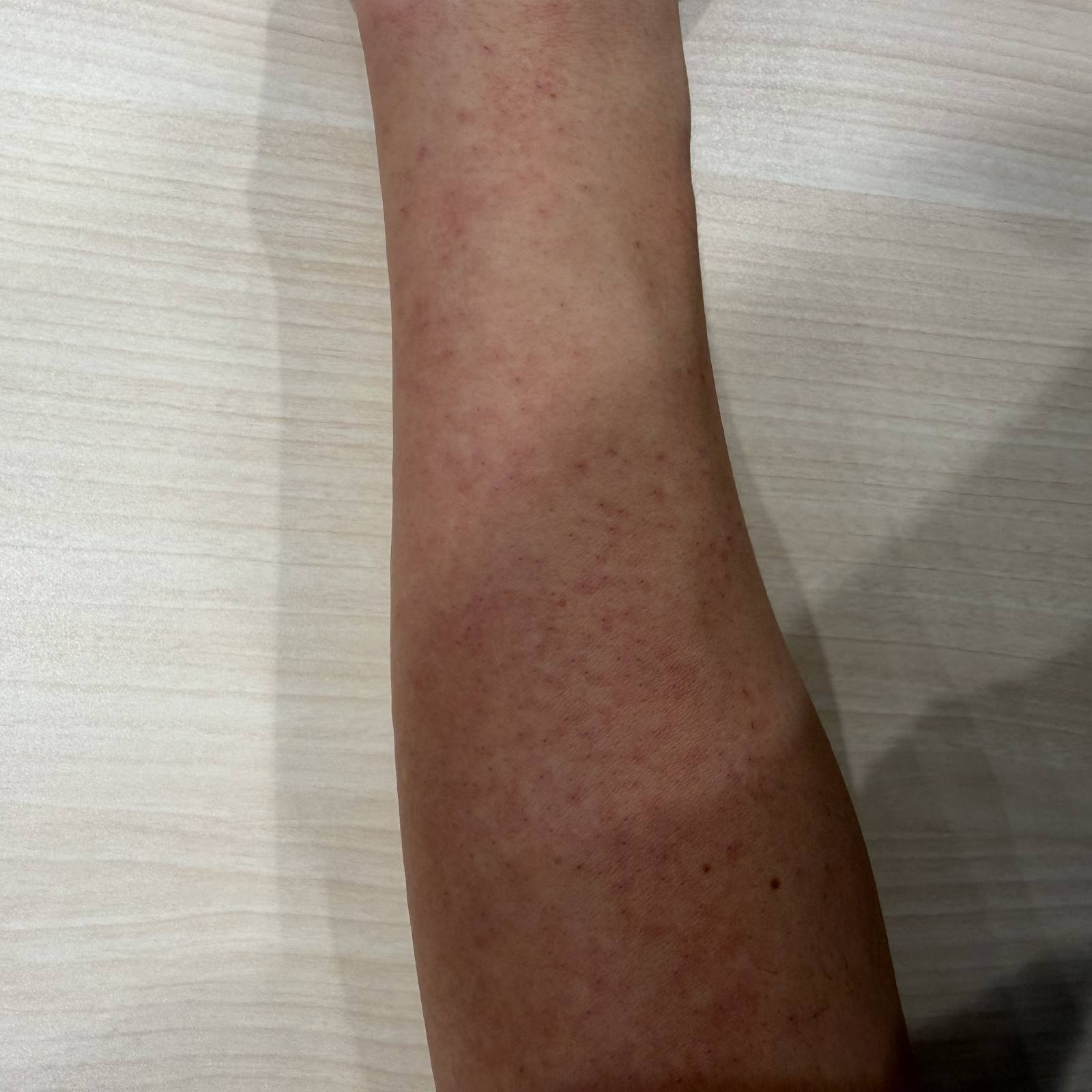 医療脱毛から3日後に腕へ赤みが残っている写真